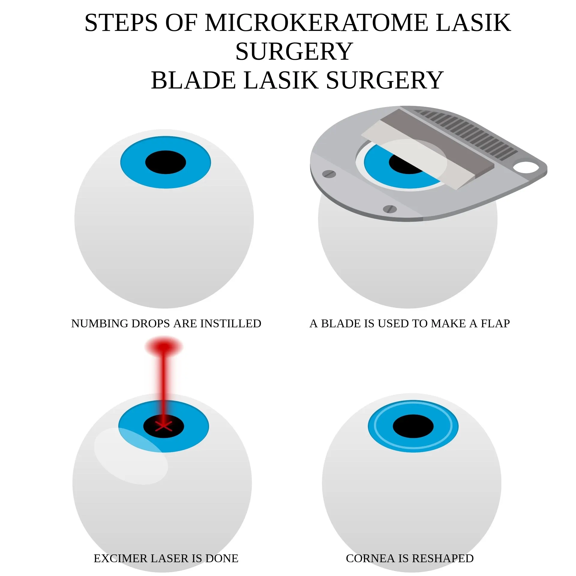 steps of lasik surgery